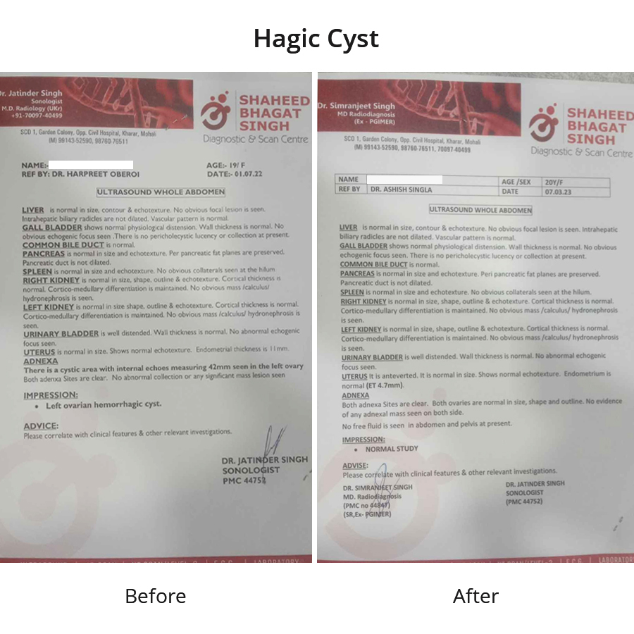 4cm Hagic Cyst cured in six months via Homeopathy - Dr Ashish Singla | Kharar