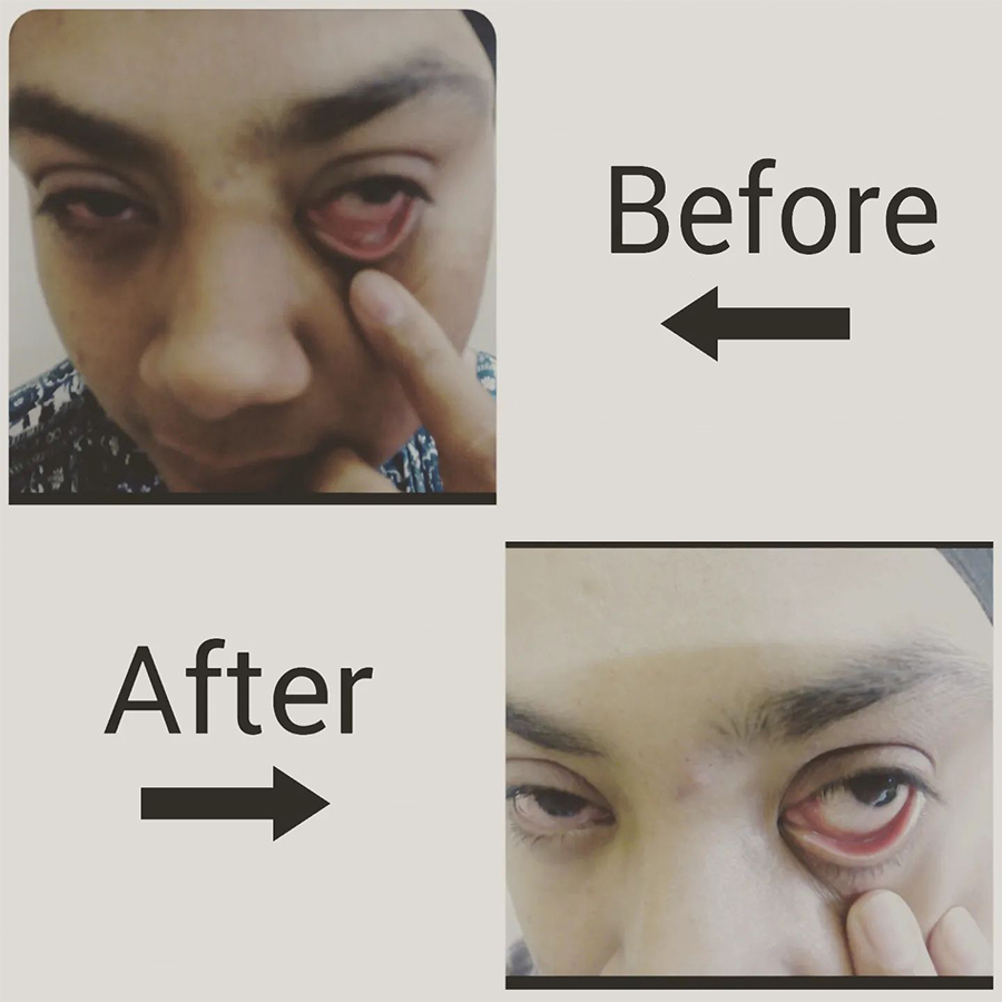 Ulcer in eye got cured within 3 days with only homoeopathic medicines - Dr Ashish Singla | Kharar