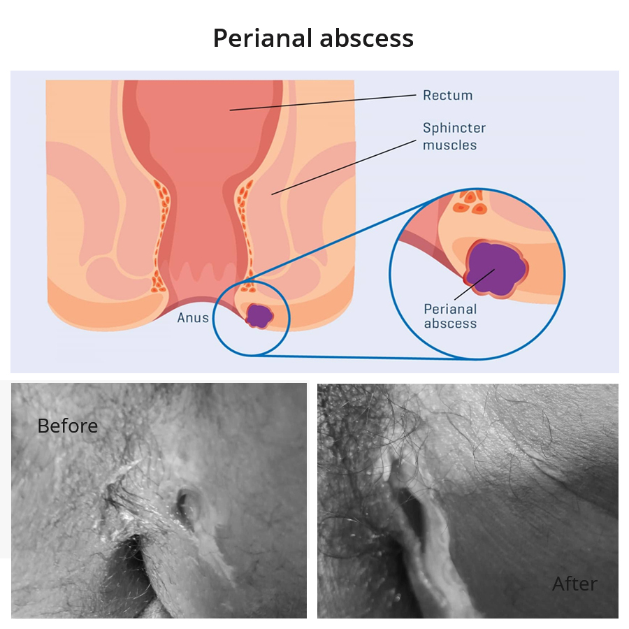 Perianal abscess cured with Homeopathy at Singla Homeo Clinic - Dr Ashish Singla