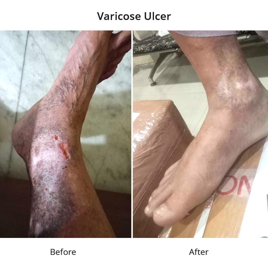 Varicose Ulcer of 2 years cured in 2 months through Homeopathic treatment - Dr Ashish Singla | Kharar